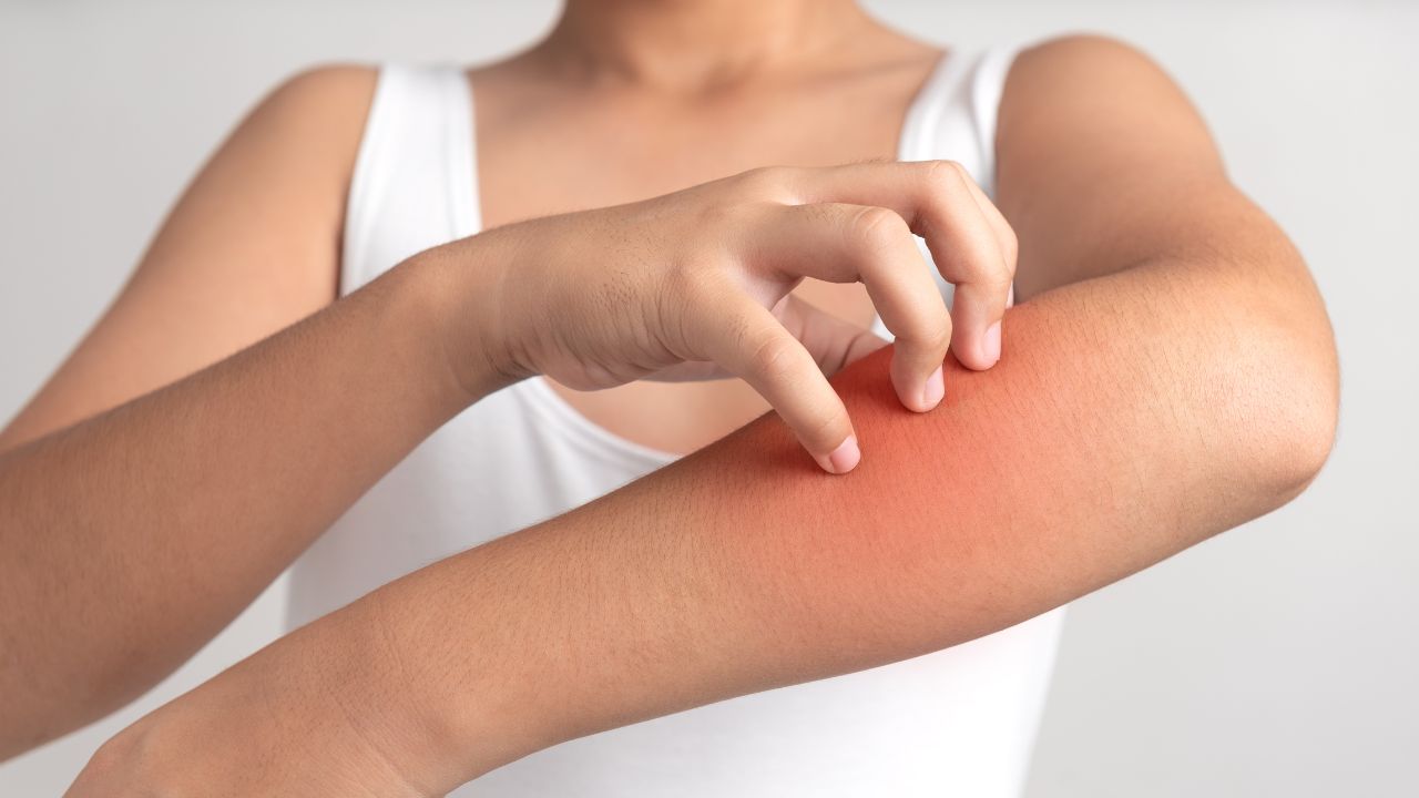 Saiba quais são as causas e os sintomas de alguns tipos de dermatites e alergias que surgem durante o verão